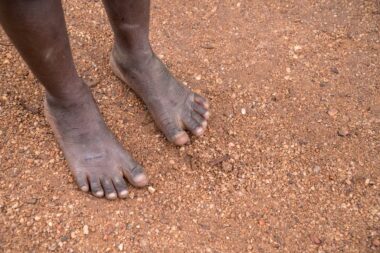 The Feet of Child Living in Poverty in Uganda, Africa